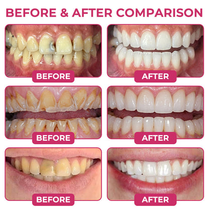 TopSpire® DenPerm Cavity-Repair Natural Enamel Filling Gel